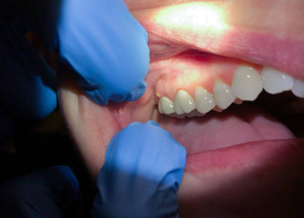 Best Emergency Care for Gum Disease in Keenesburg, CO